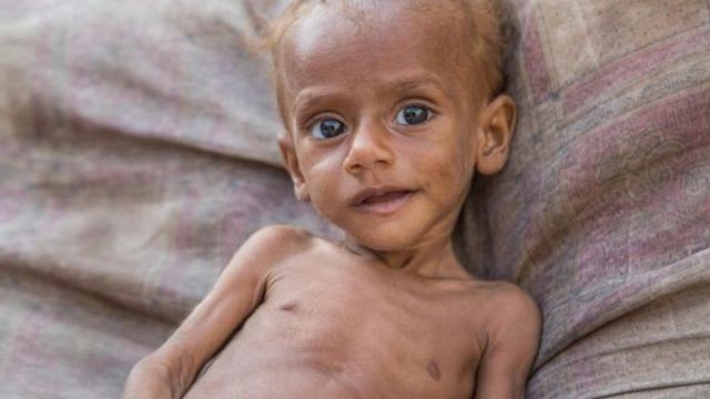 منظمة الصحة العالمية: 75 بالمئة من أطفال اليمن يعانون من سوء التغذية المزمن