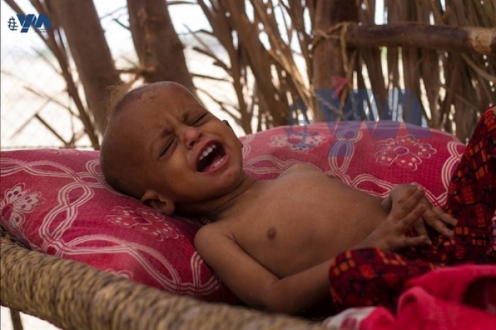 الصحة العالمية تعلن بدء علاج 18 ألف طفل يمني يعانون من سوء التغذية