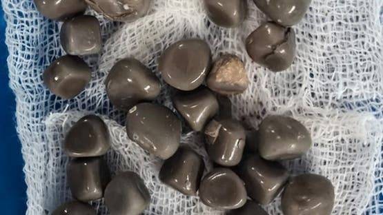 مصر.. فريق طبي ينجح في استخراج 58 حصوة من كلية مريض