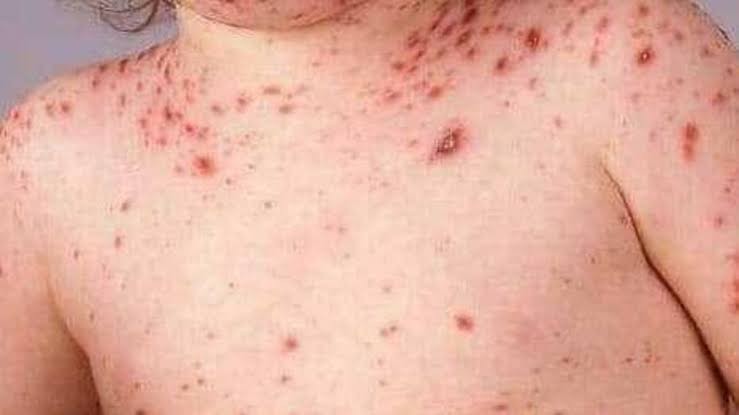 87 وفاة وأكثر من 14 ألف إصابة بالحصبة في مناطق الحكومة خلال 6 أشهر